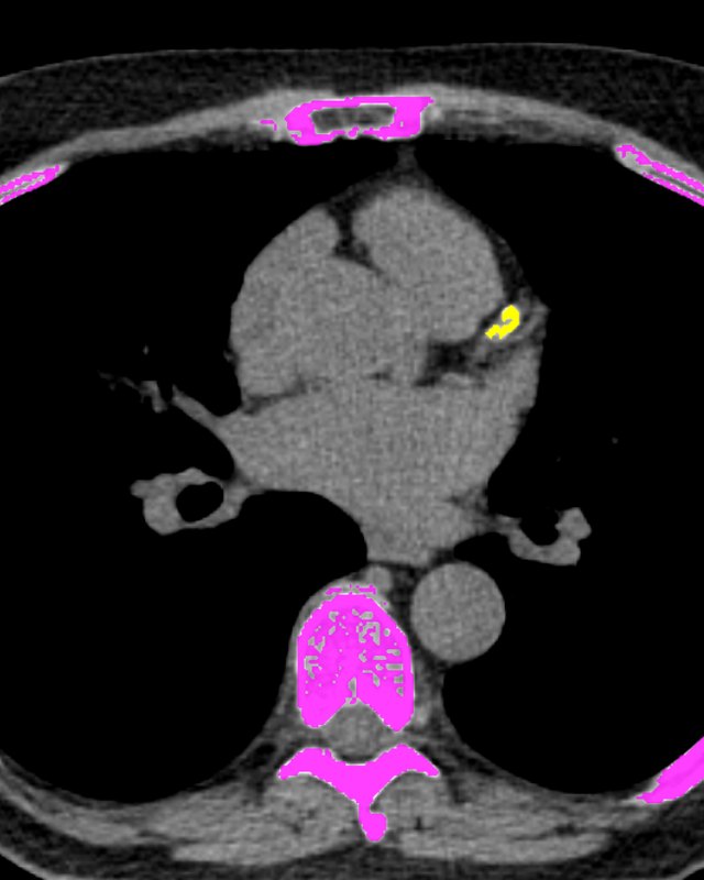 Tomografía del corazón para la puntuación de calcio, con el calcio de una arteria coronaria marcado en amarillo