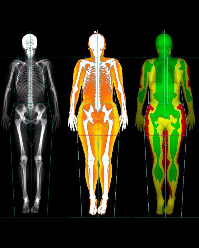 Estudios DEXA de cuerpo entero: el esqueleto y mapas de color de hueso, grasa y músculo