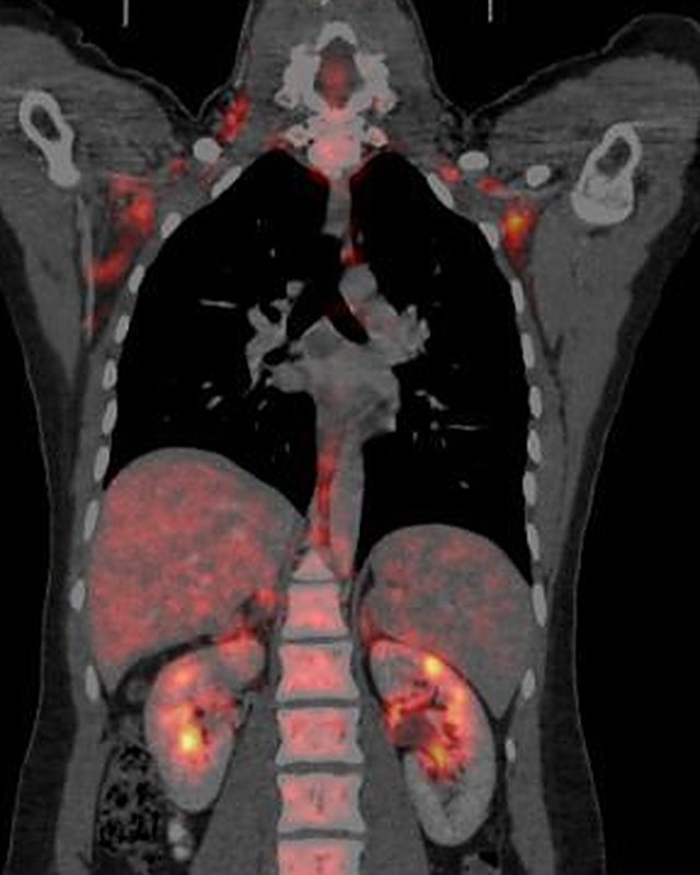 Estudio de PET-CT del cuerpo, con la imagen del PET sobre la del CT