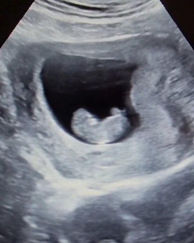 Imagen de ultrasonido de un estudio de embarazo