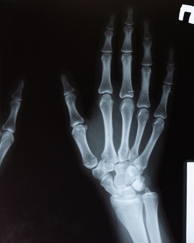 Radiografía de una mano